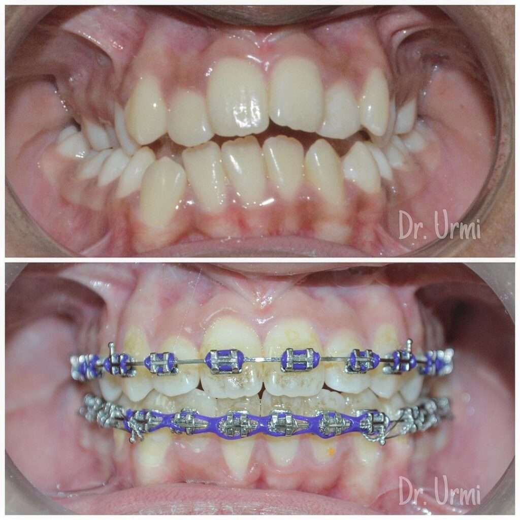 Dental Braces in Dubai